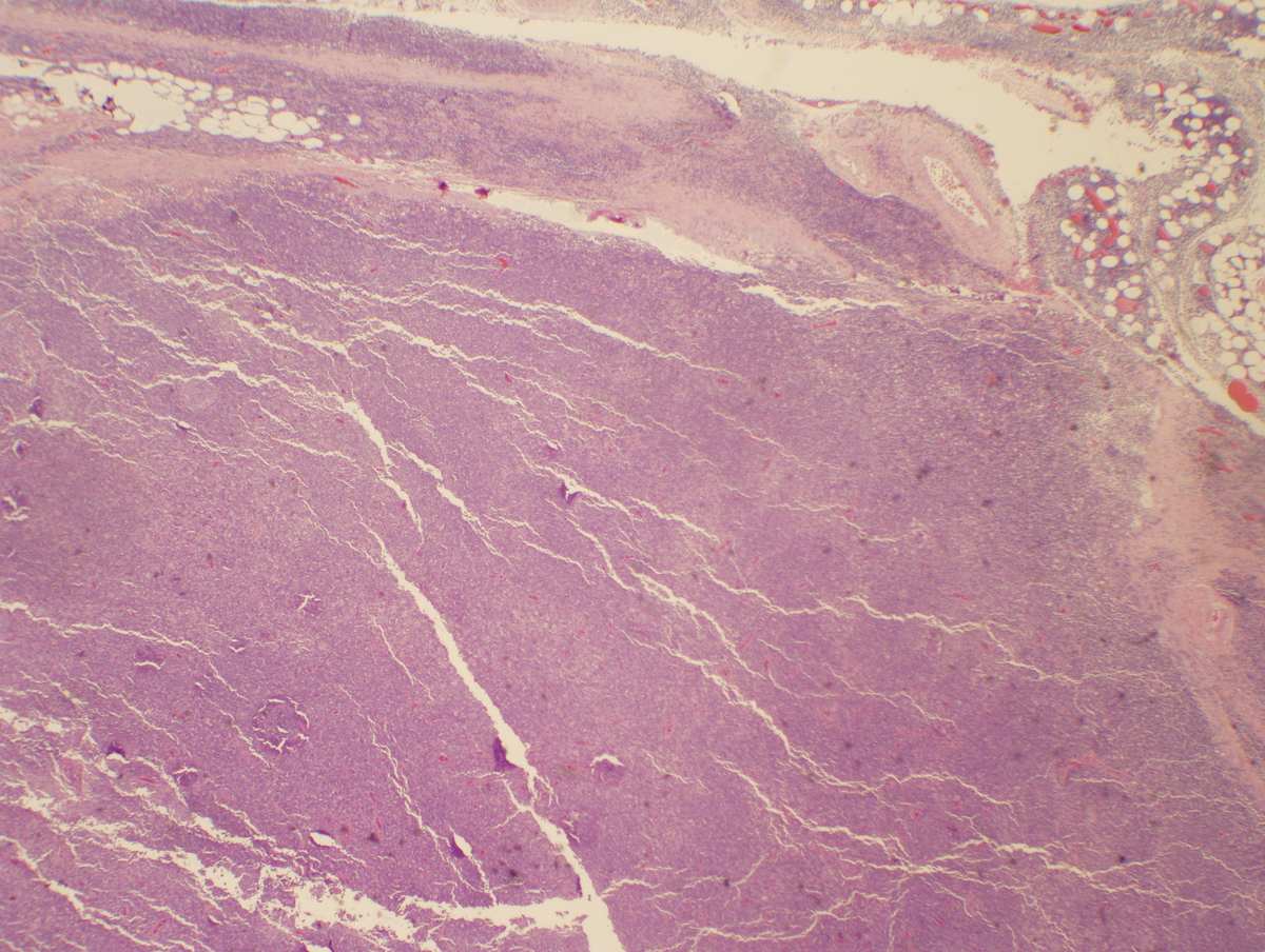 Left axillary lymph node (2x)